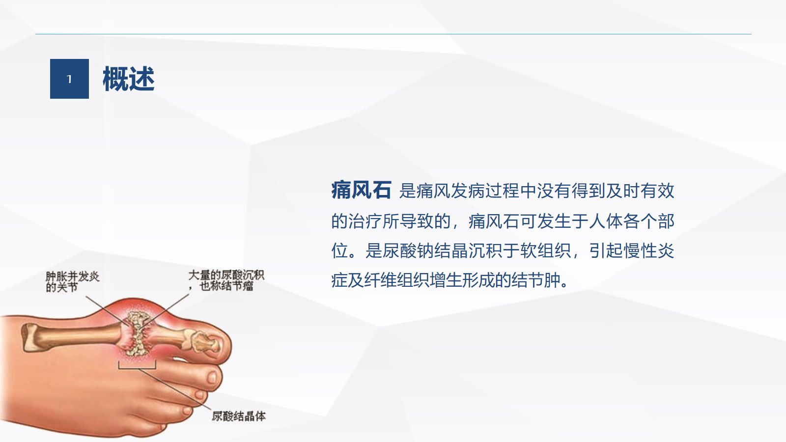 痛风石病人的护理 第4页