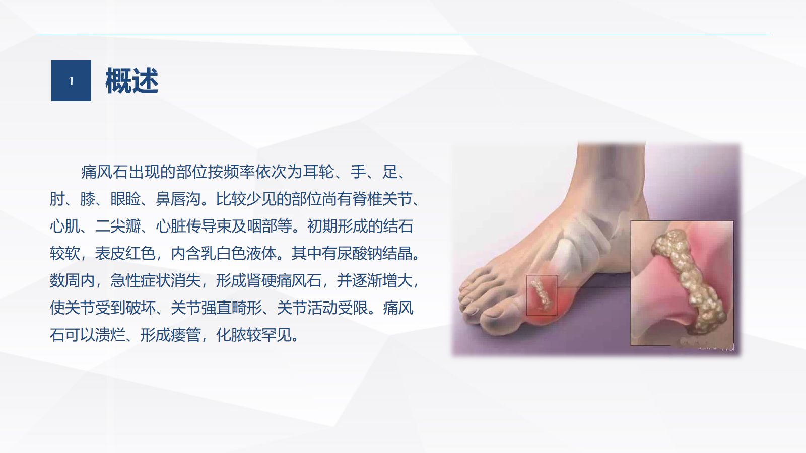 痛风石病人的护理 第5页