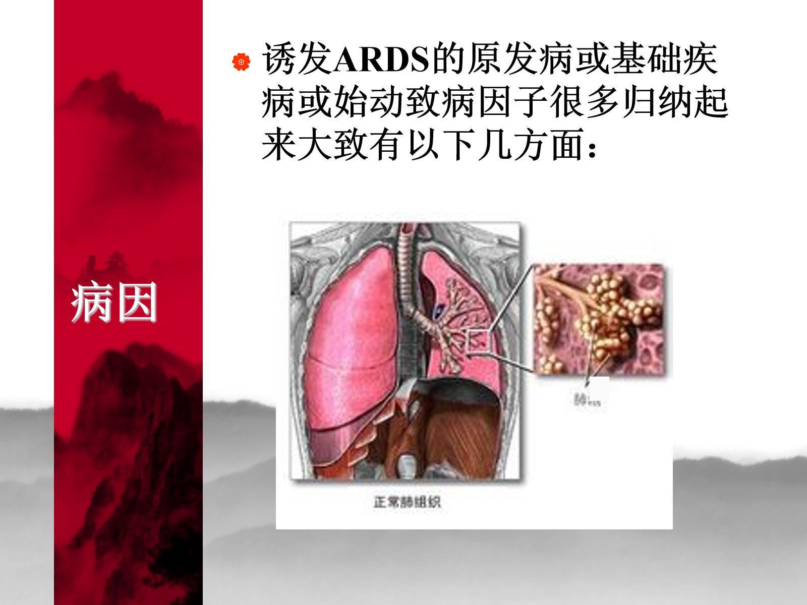 ARDS护理查房 第3页