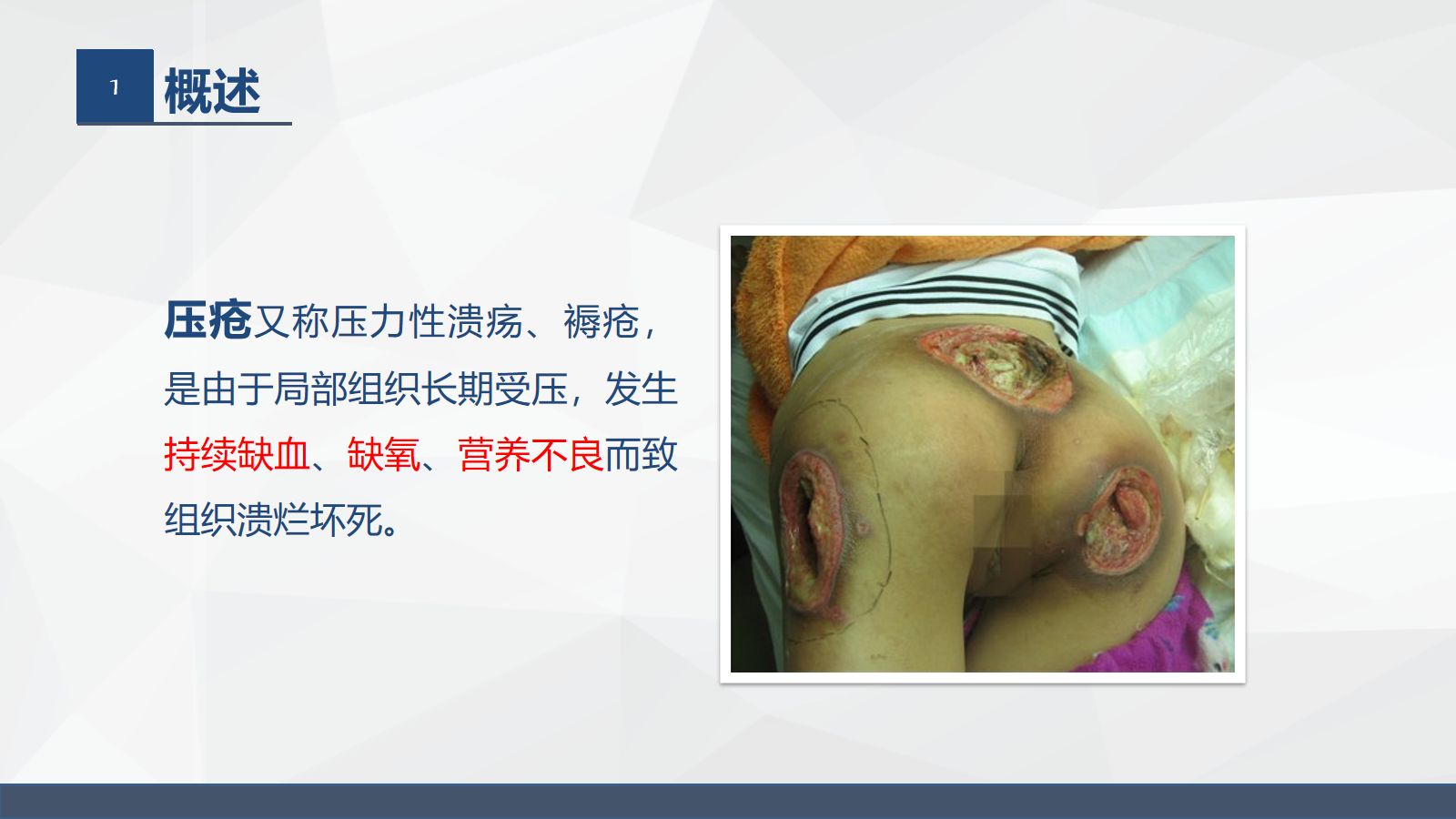 压疮的护理 第4页