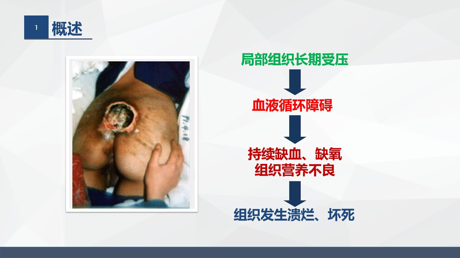 压疮的护理 第5页