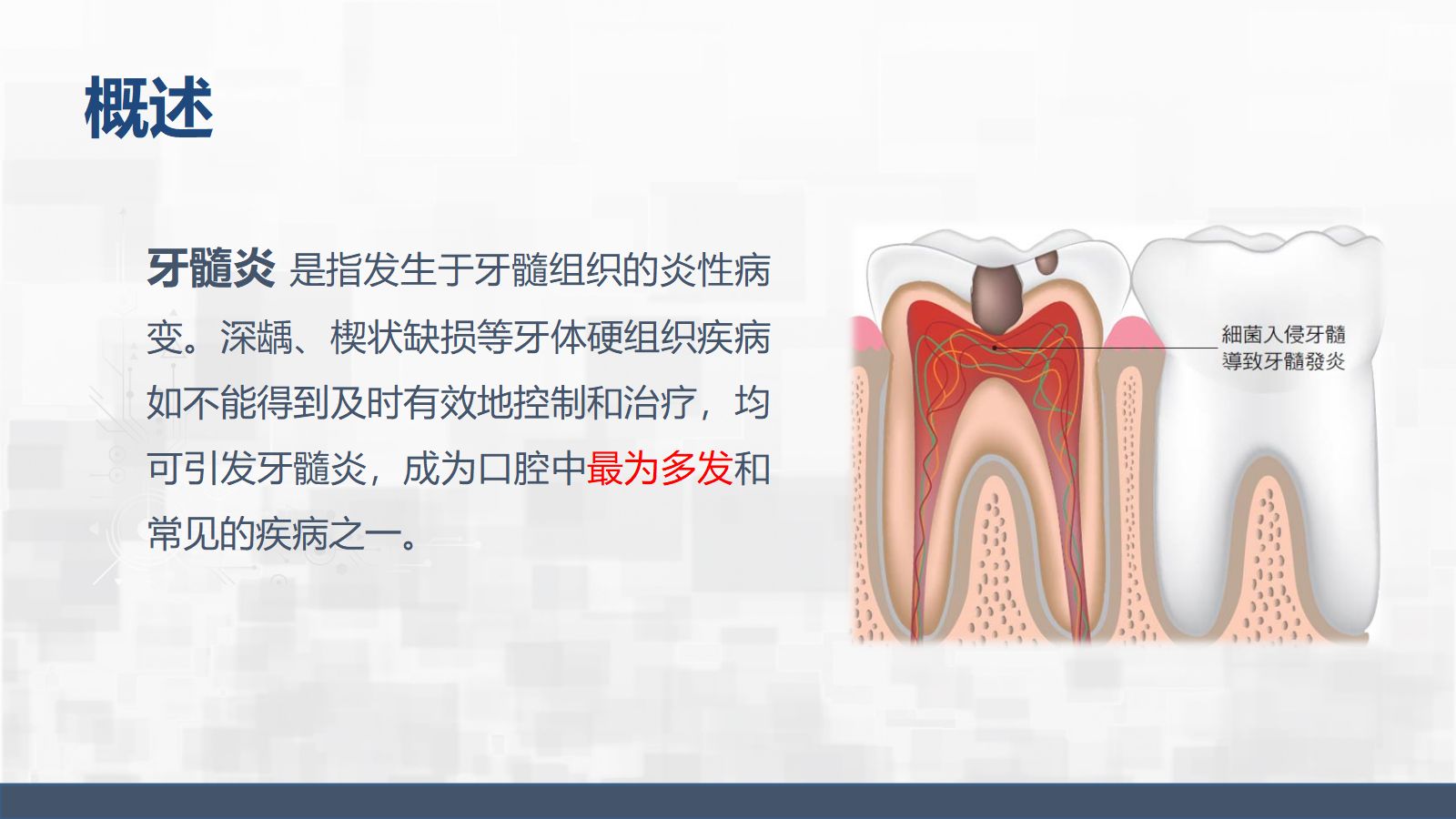 牙髓炎护理查房 第4页