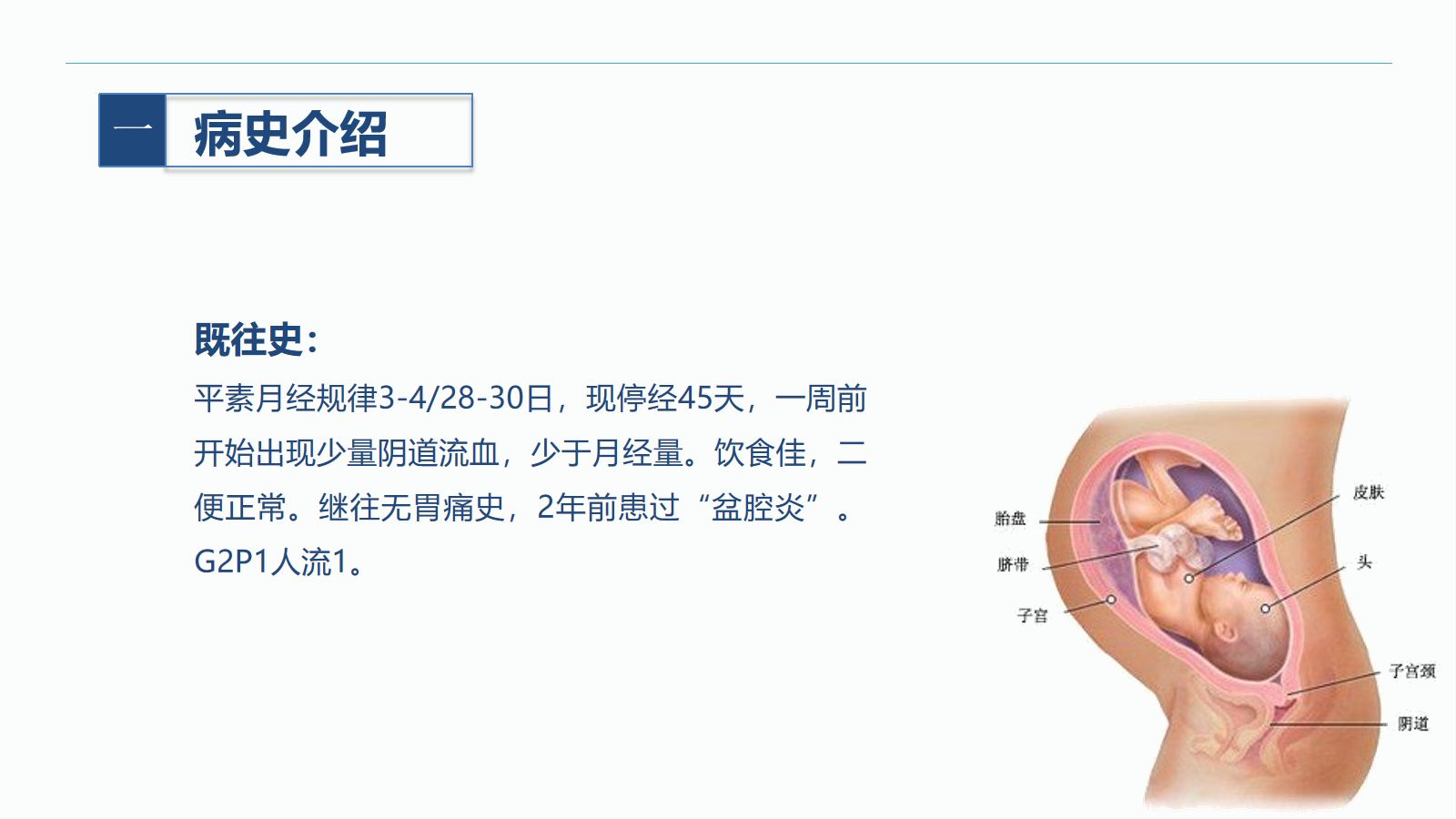 异位妊娠 第4页