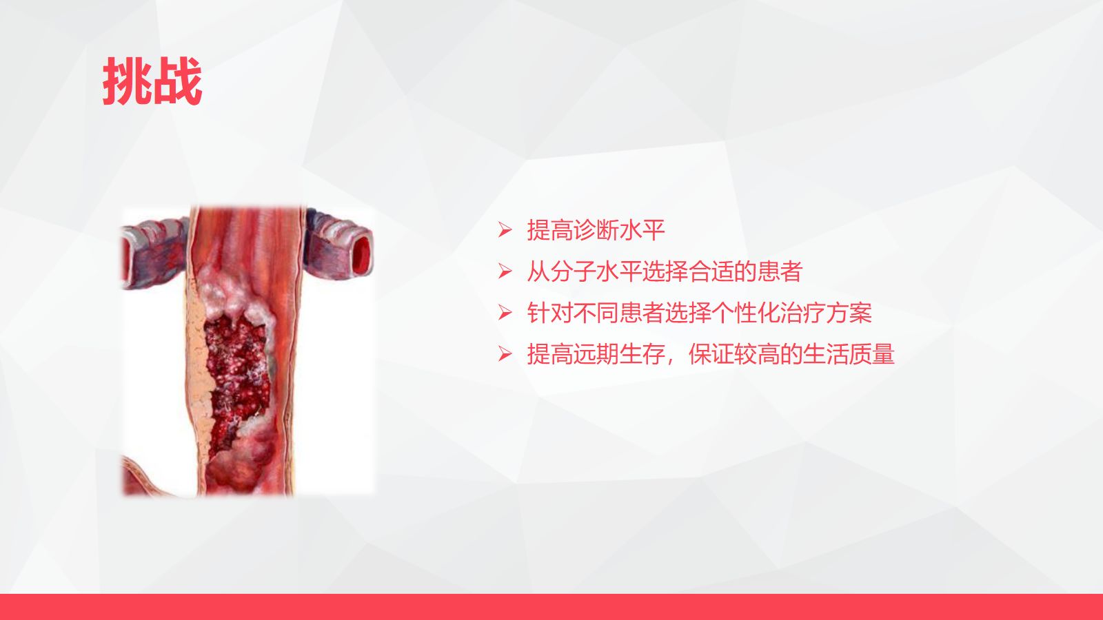 局部晚期食管癌新辅助治疗 第5页