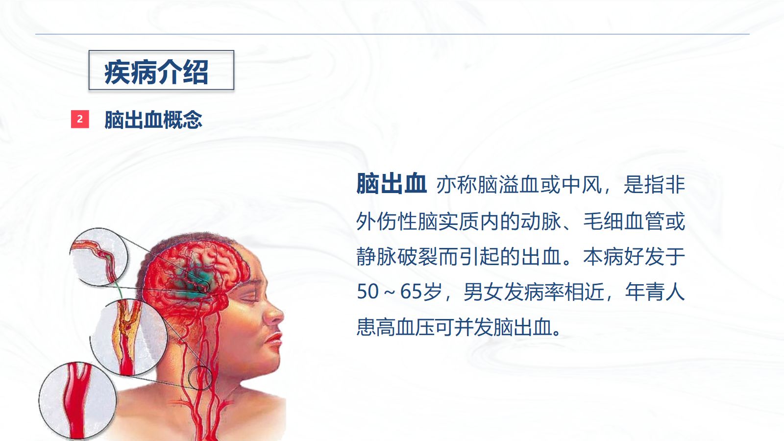 脑出血疾病介绍+术后护理 第5页