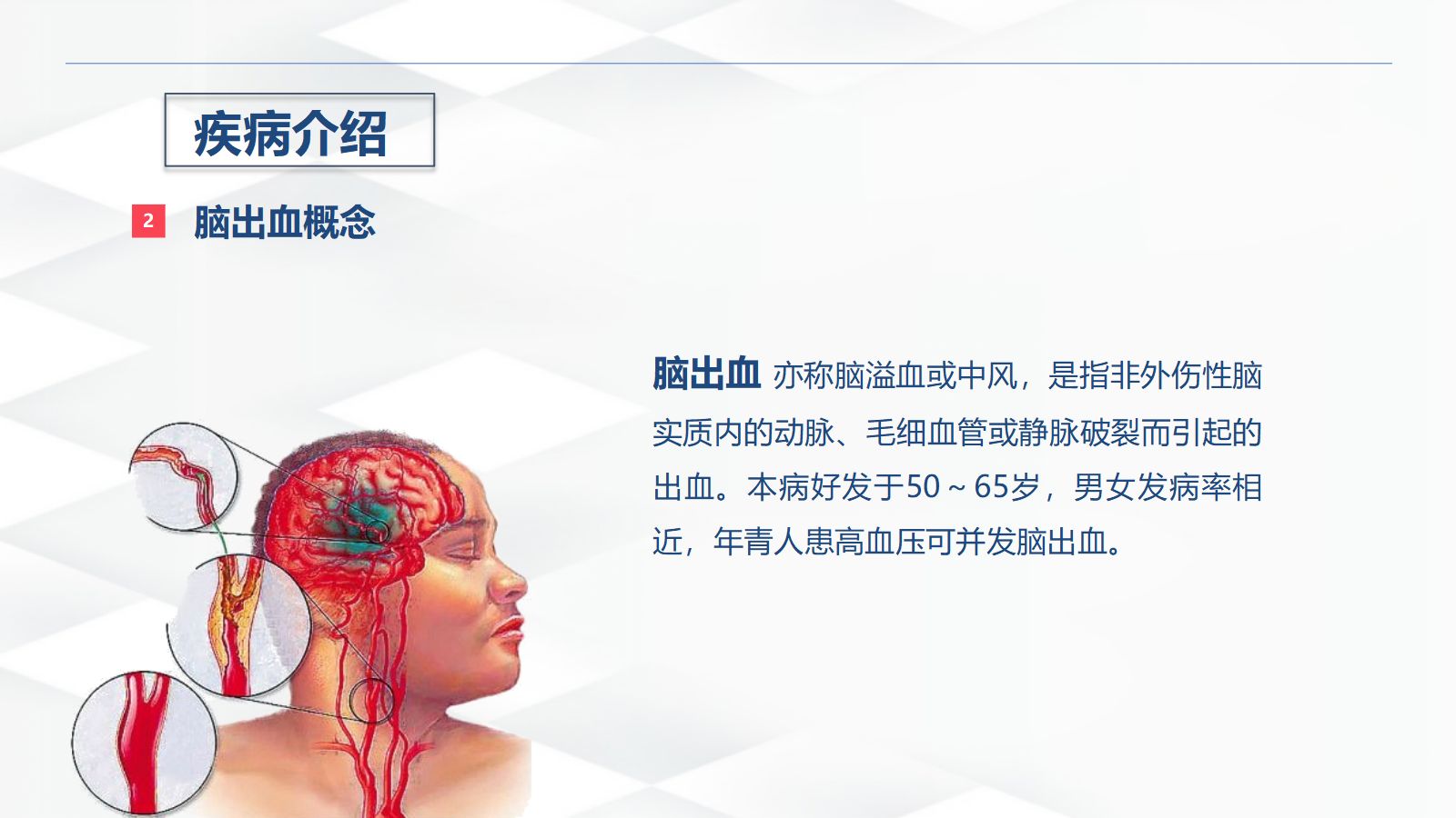 脑出血的术后护理 第5页