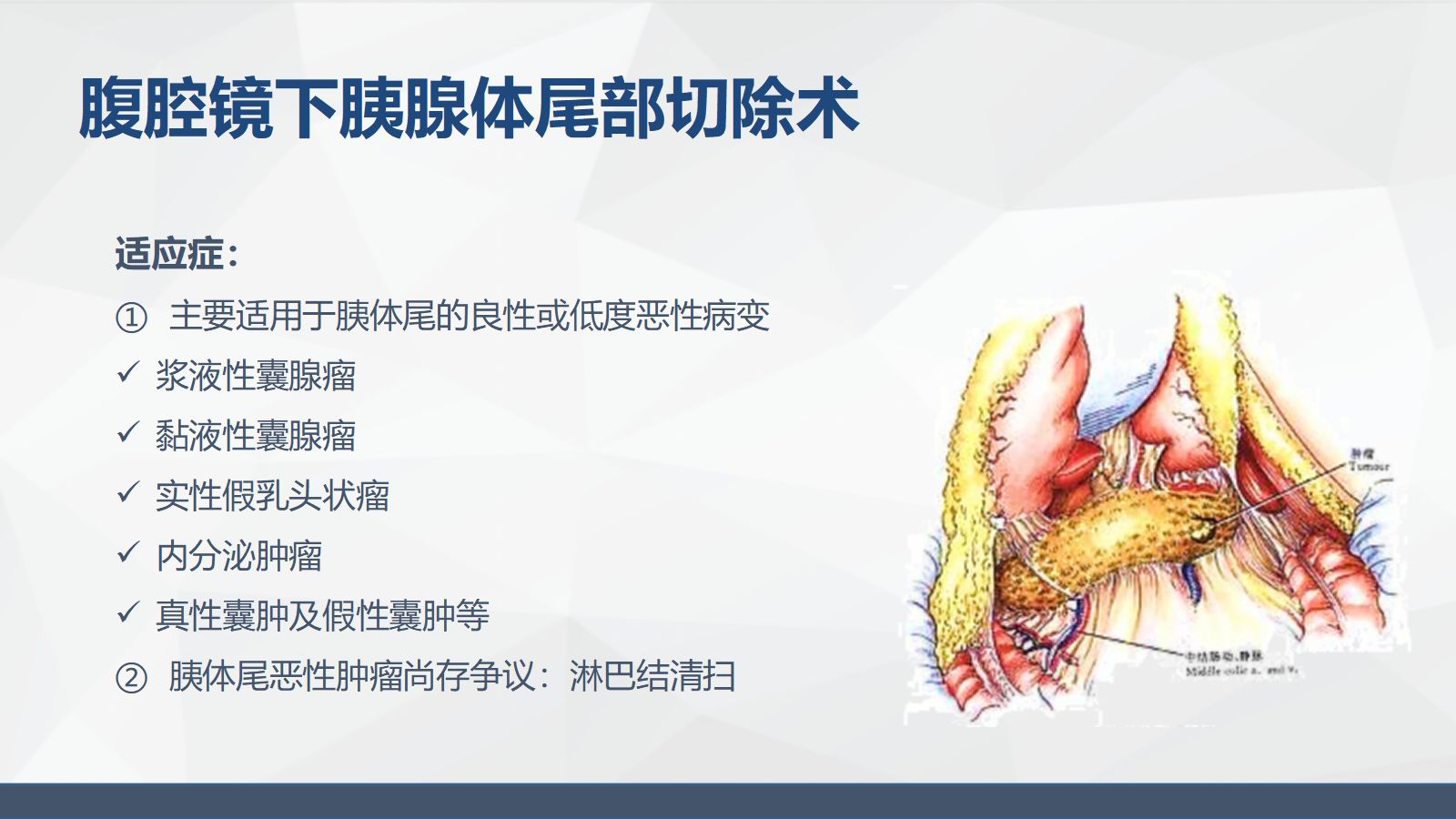 腹腔镜胰体尾手术护理配合 第5页