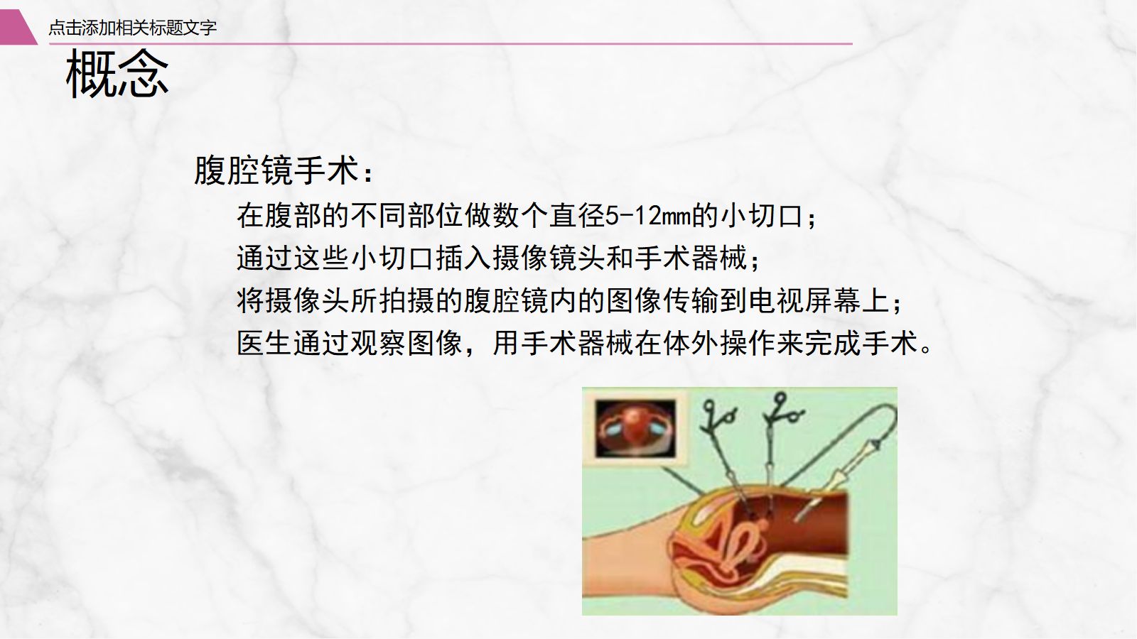 腹腔镜围手术期护理 第4页