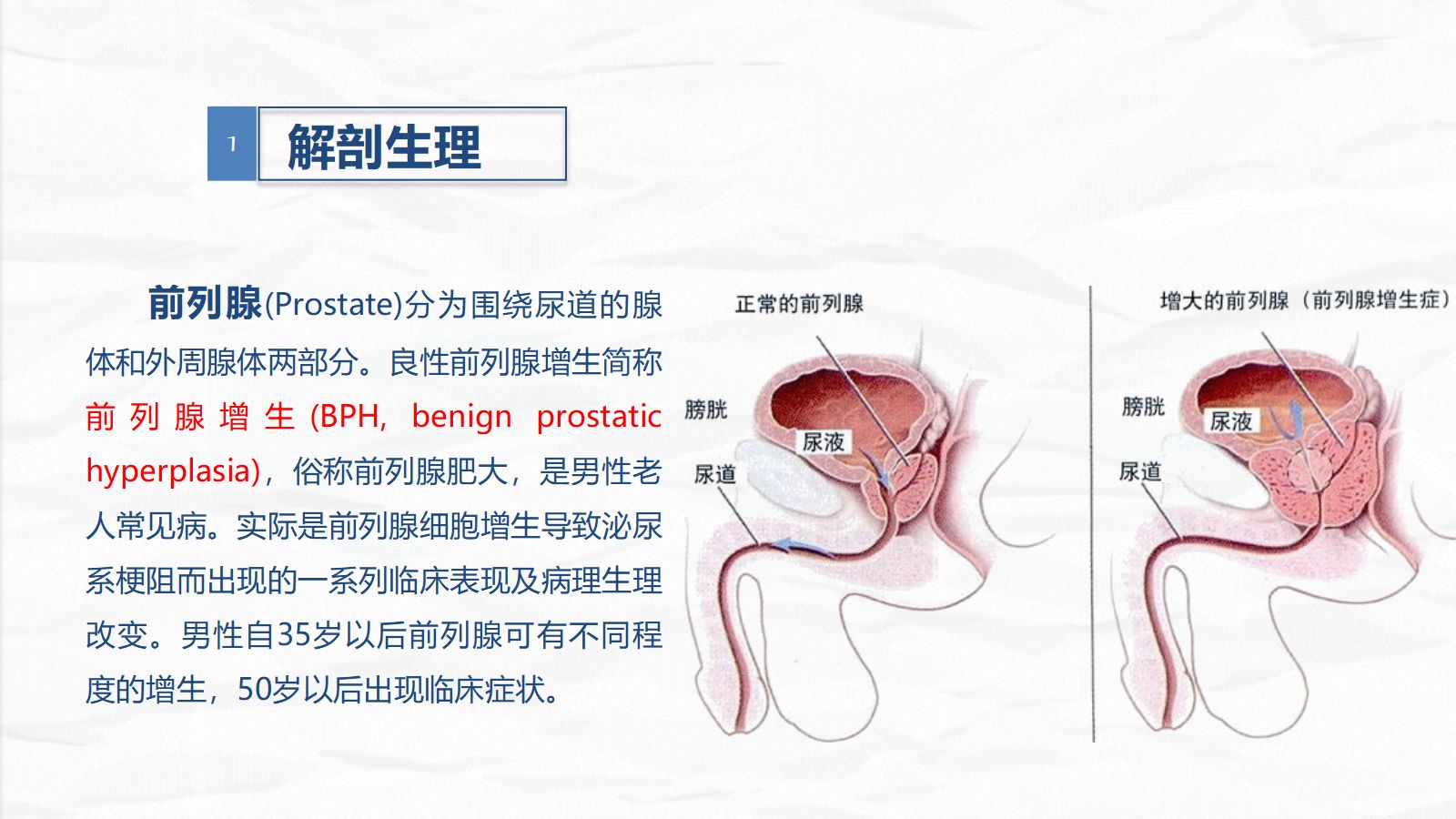 28男科-前列腺增生护理查房 第4页