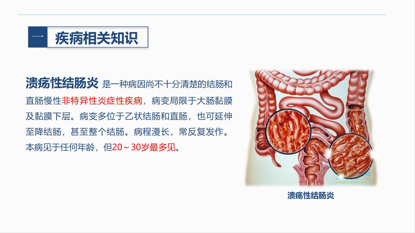 60消化内科-溃疡性结肠炎护理查房 第4页