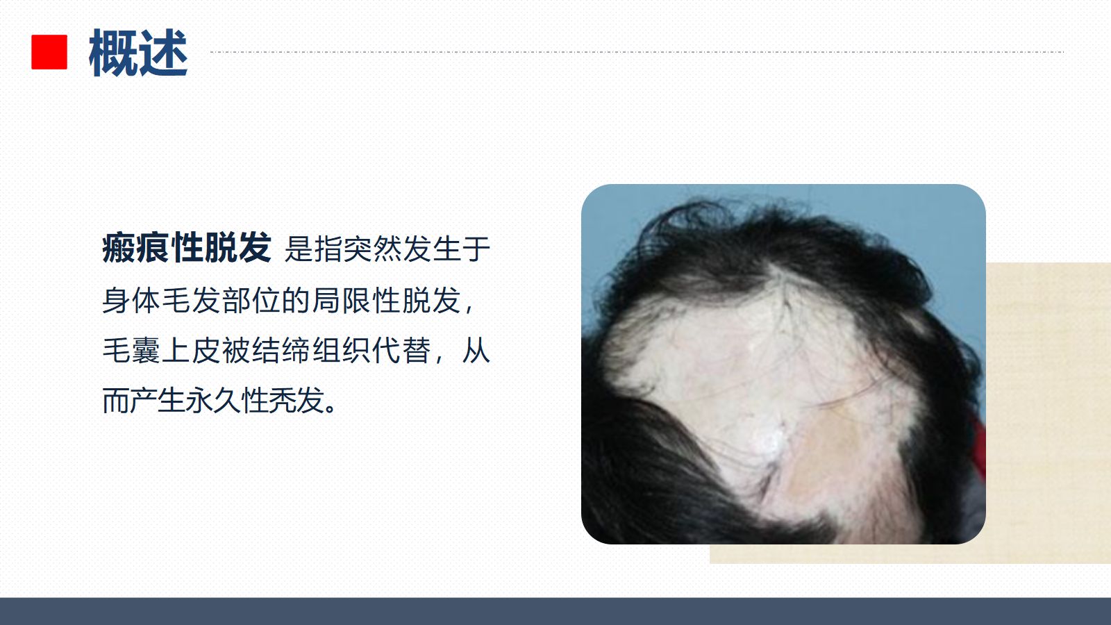 40皮肤科-瘢痕性脱发患者的护理查房 第4页