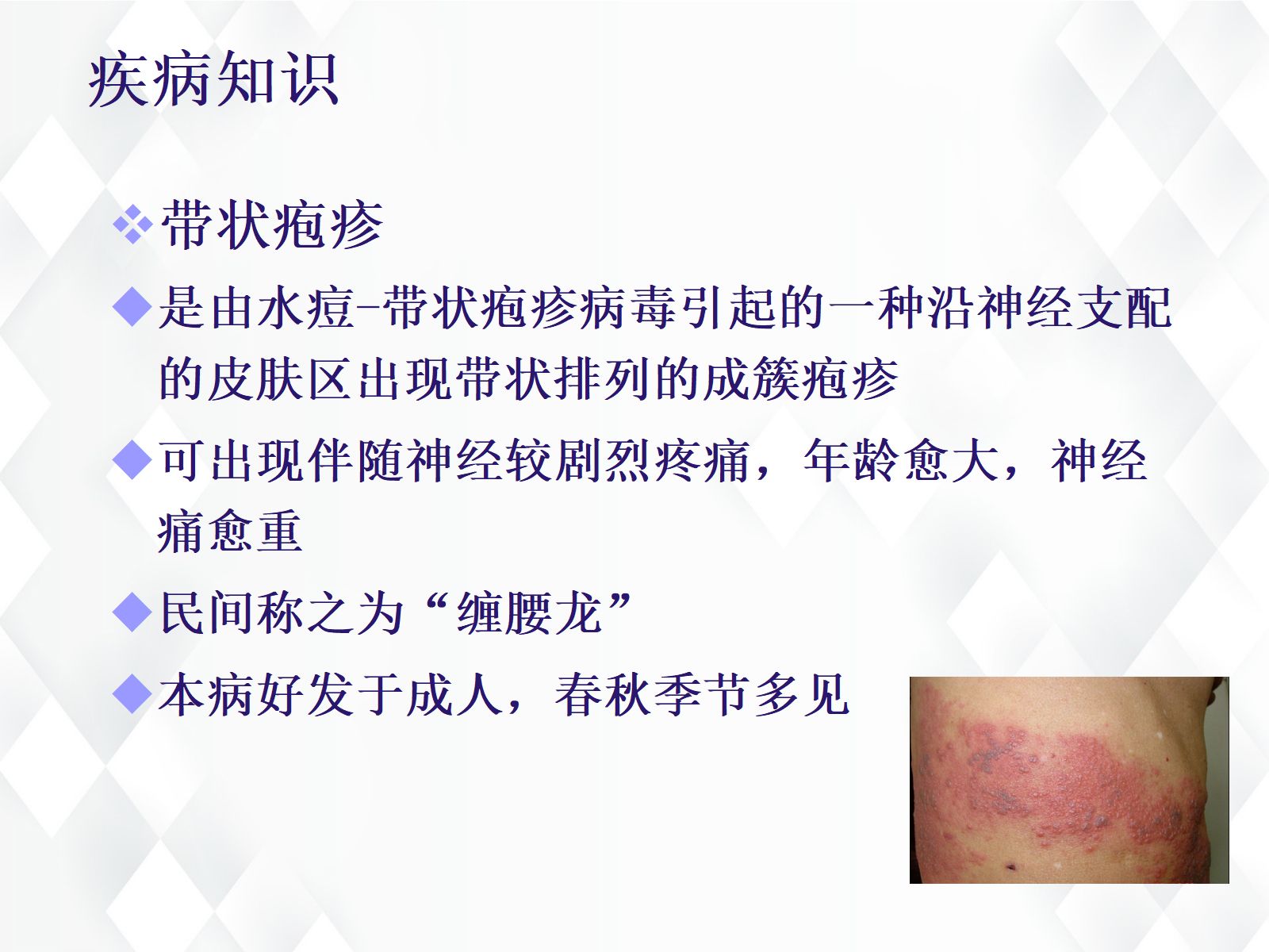 41皮肤科-带状疱疹后遗神经痛护理查房 第3页