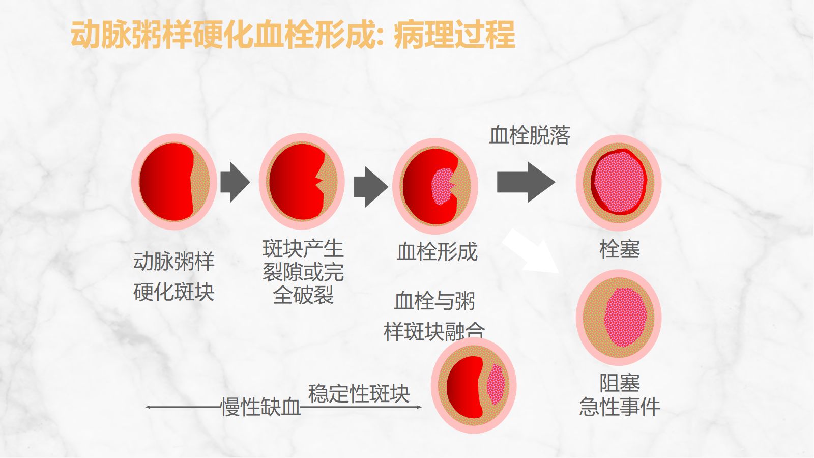 急性脑梗死的溶栓及抗栓治疗 第5页
