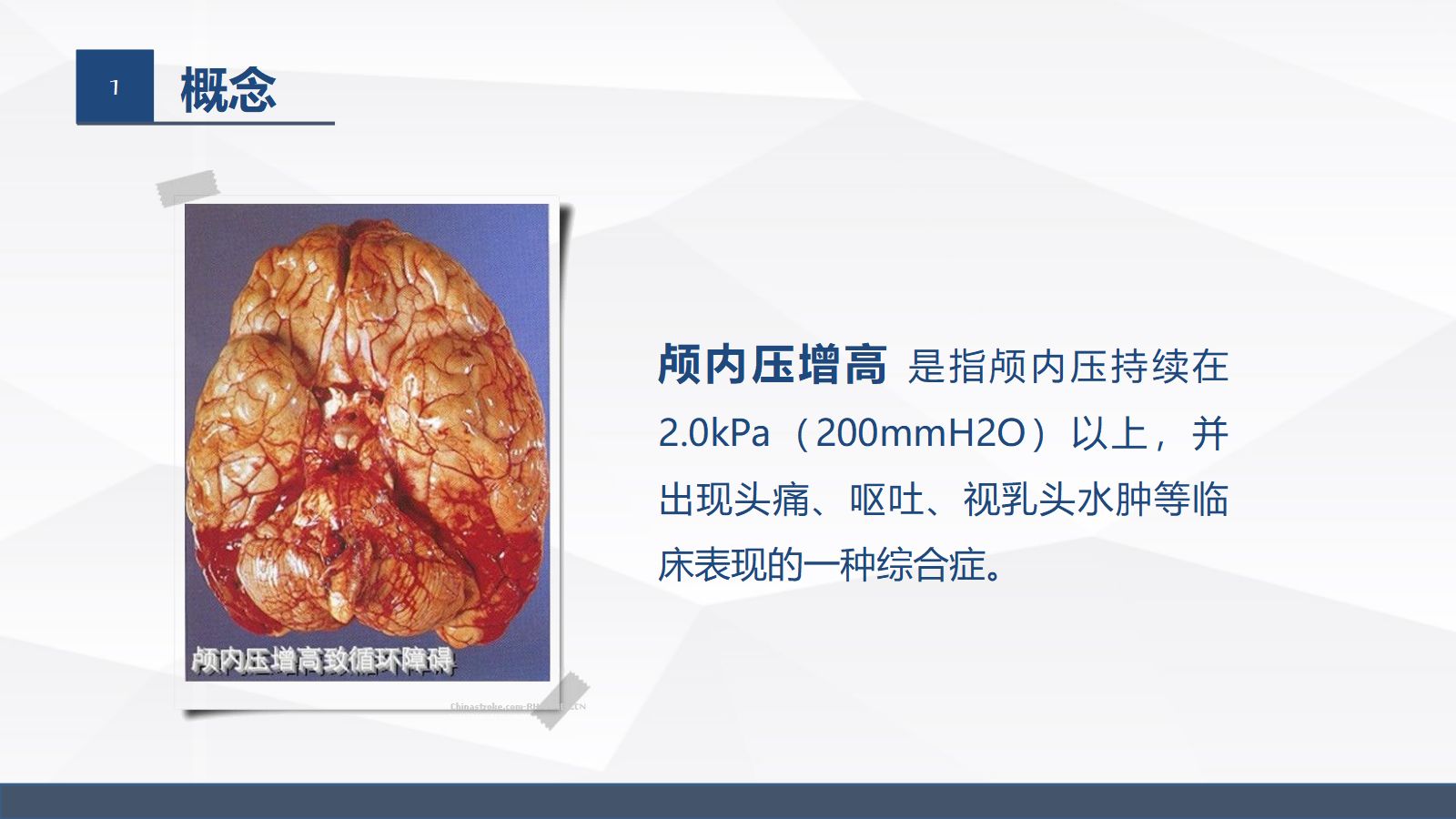 颅内压增高病人的护理 第5页