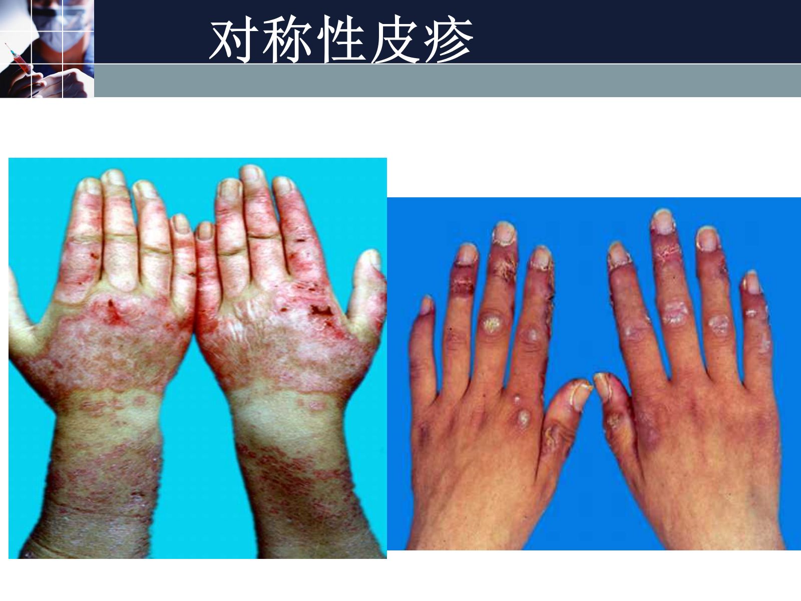 狼疮性肾炎的护理常规ppt 第5页