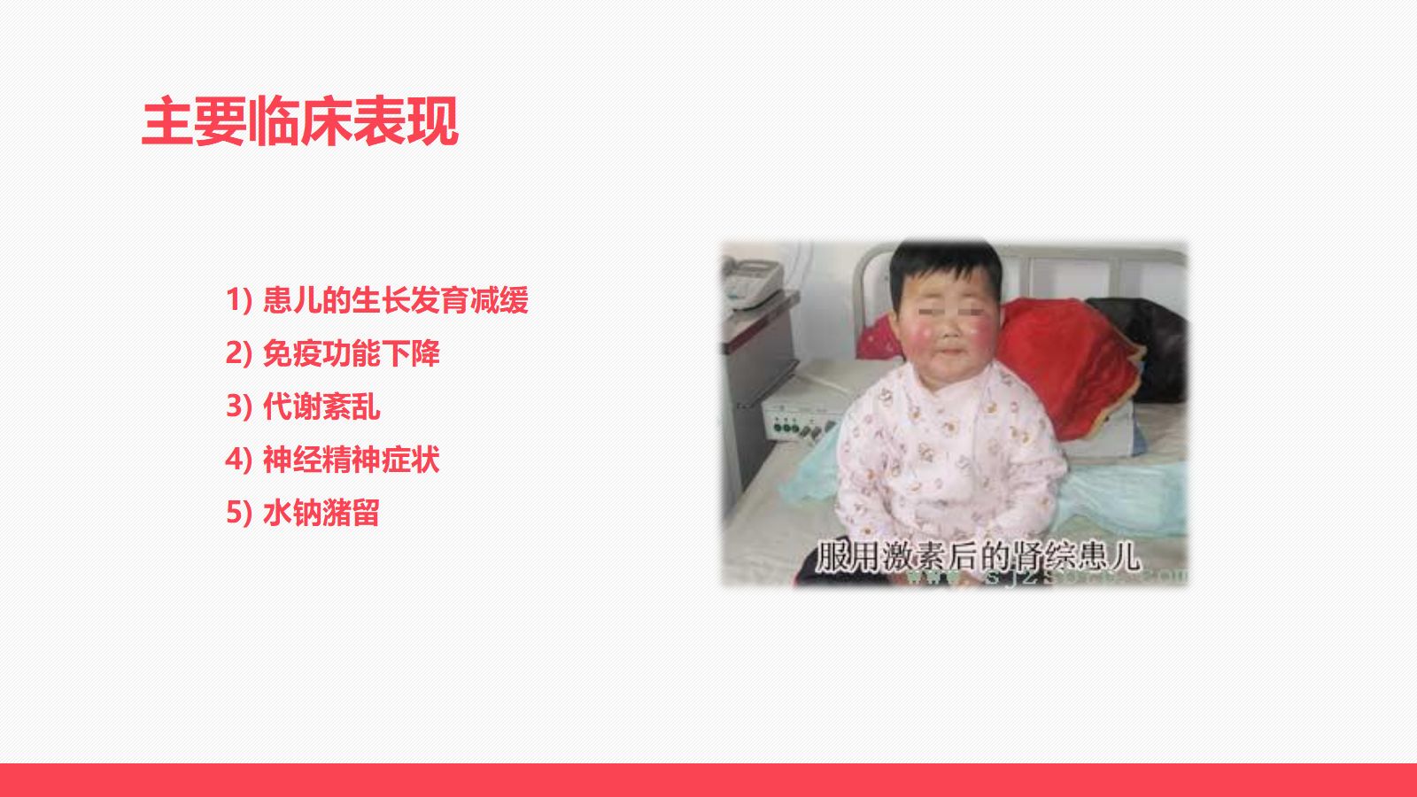 肾病患儿服用激素后的临床表现及护理 第5页