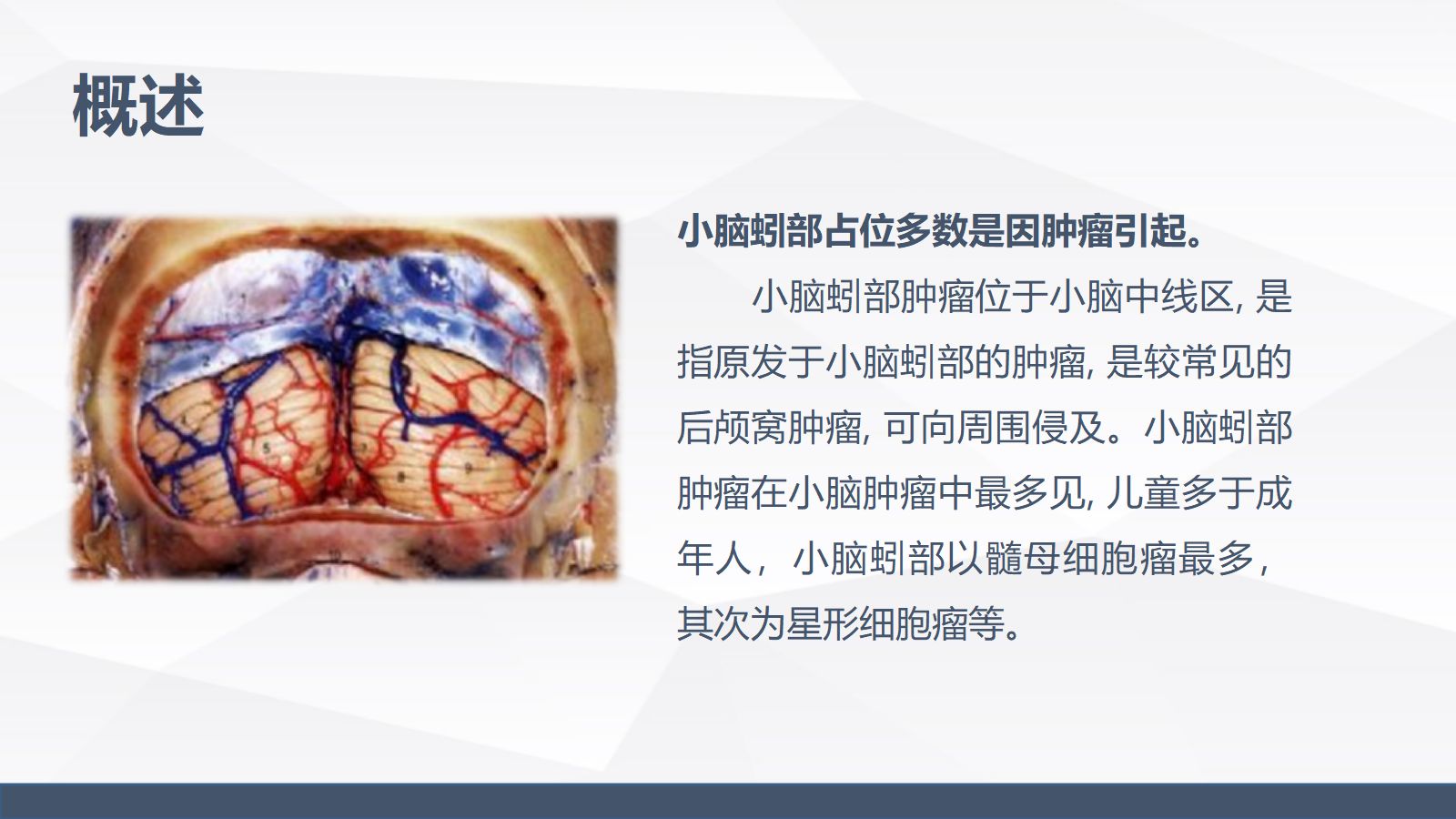 小脑蚓部占位的业务学习 第5页
