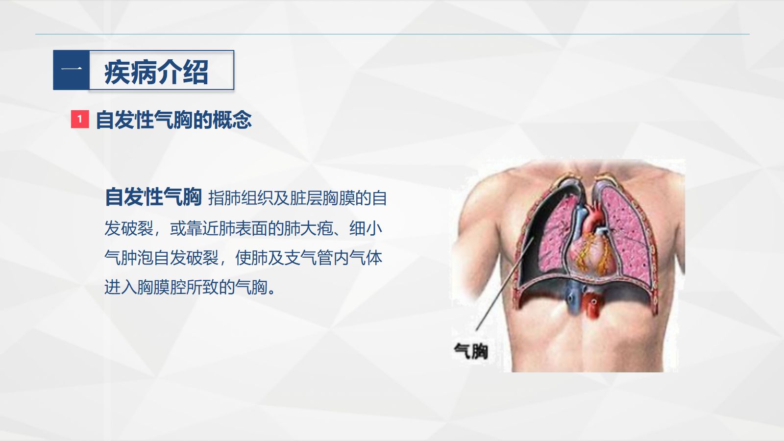 70胸科-胸膜炎患者自发性气胸的护理查房 第4页