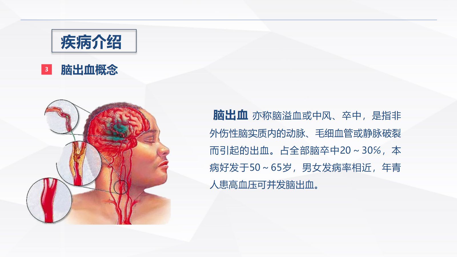 脑出血疾病介绍+术后护理 第4页