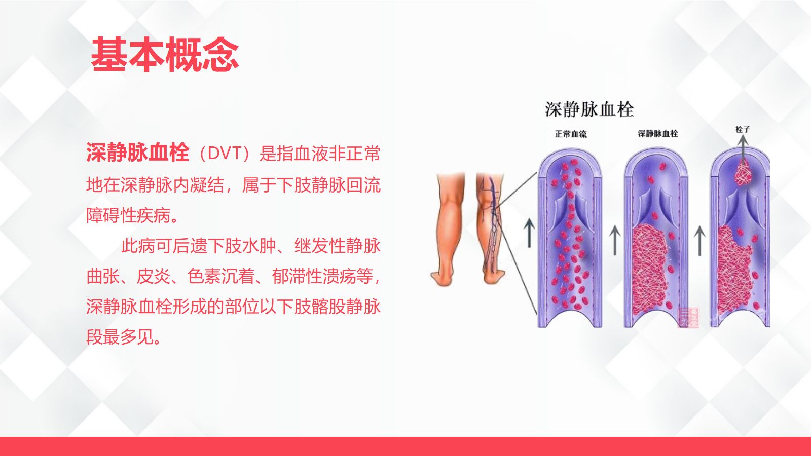 深静脉血栓的护理-业务学习 第4页