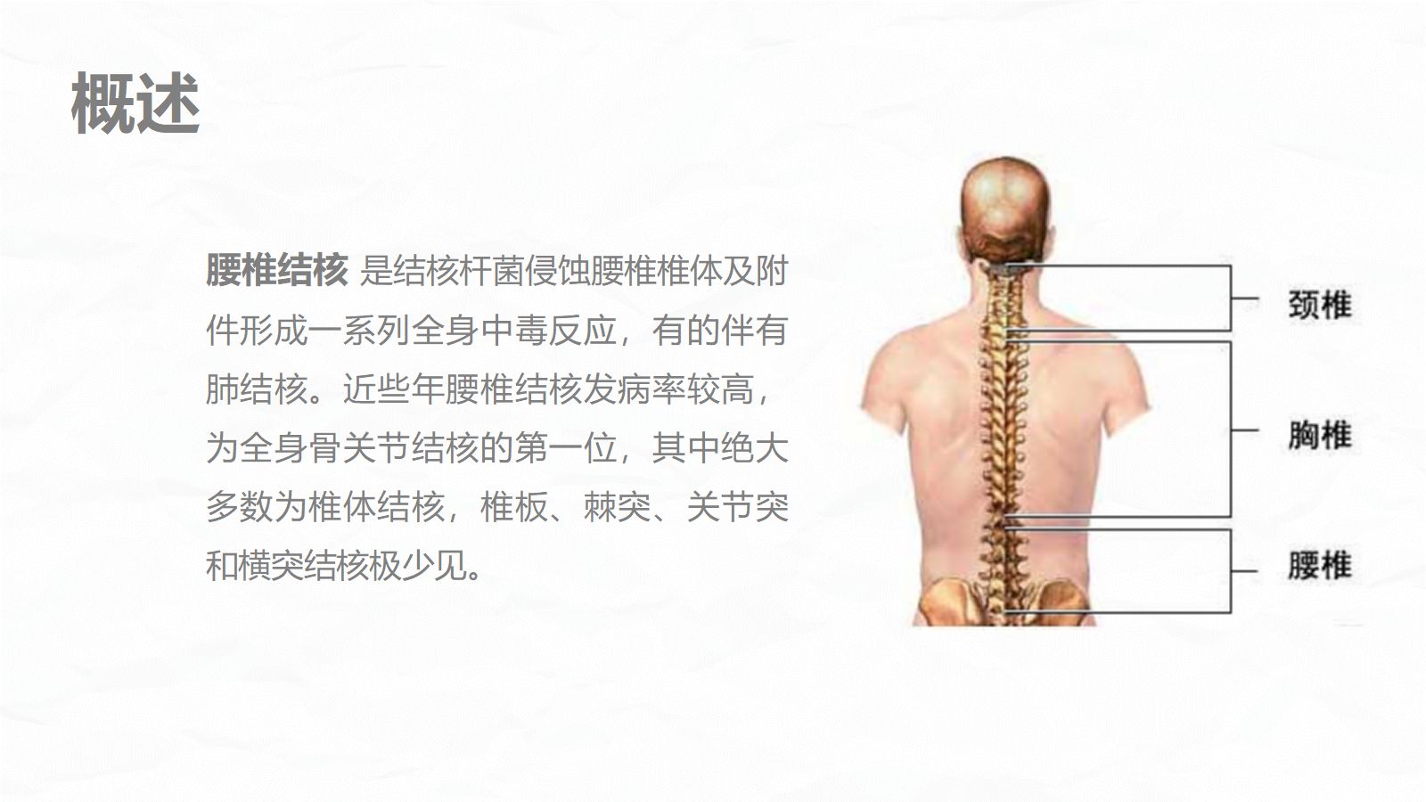 腰椎结核的围手术期护理 第4页