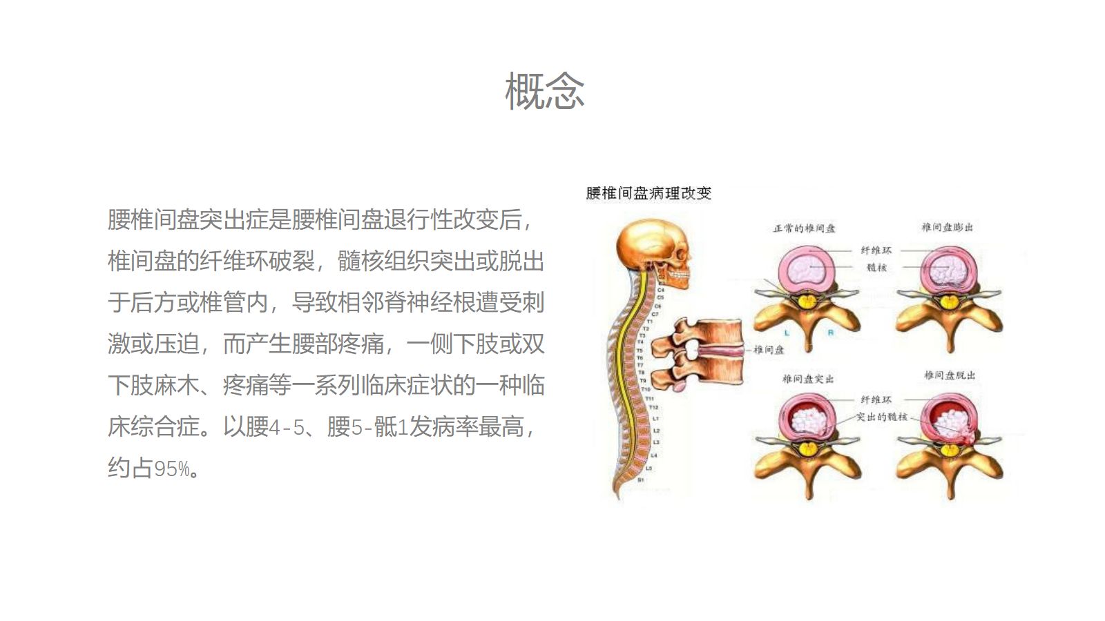 腰椎间盘突出症中医护理 第4页