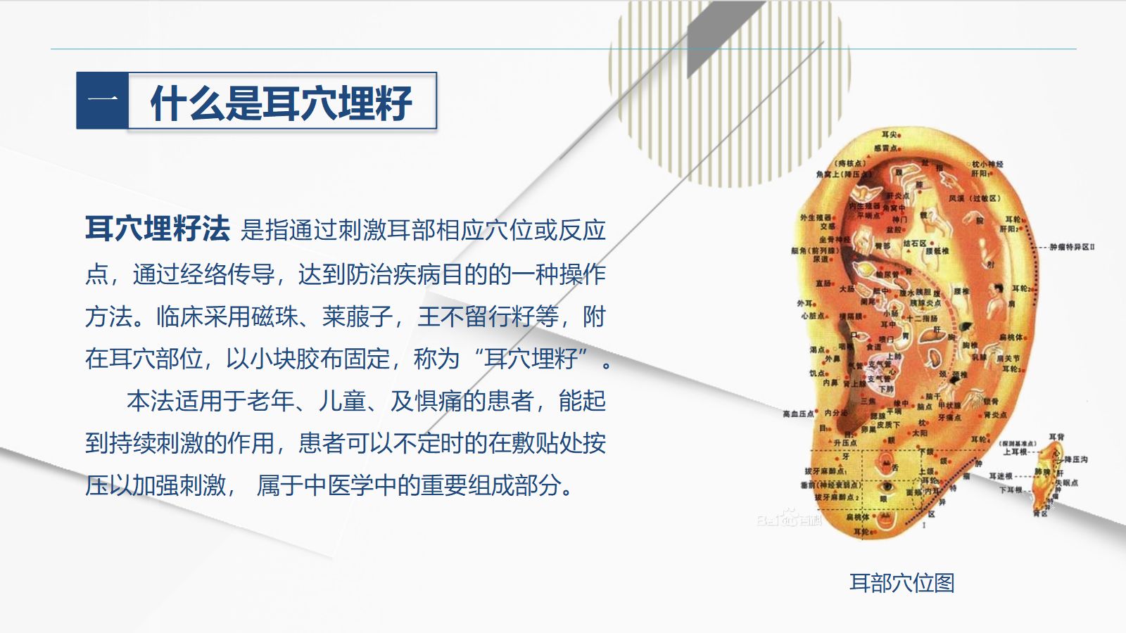 耳穴埋籽 第4页